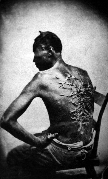 File:Cicatrices de flagellation sur un esclave.jpg