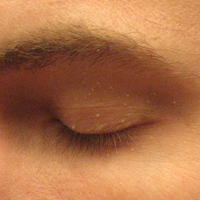 成年人的眼皮上起了一些极为细小的白色痘疤。